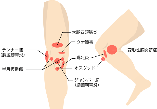 膝の痛みの種類